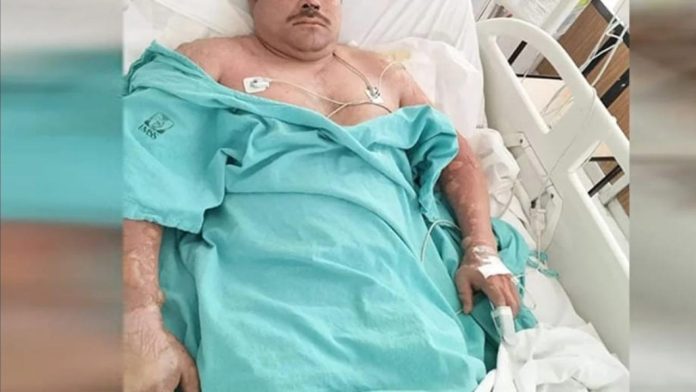Hombre sufre graves quemaduras por explosión de su celular en Coahuila
