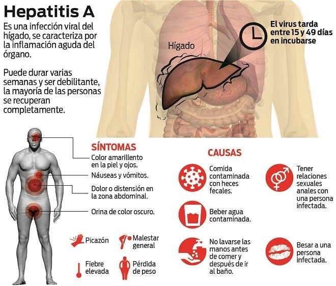 En alerta Torreón por brote de hepatitis A