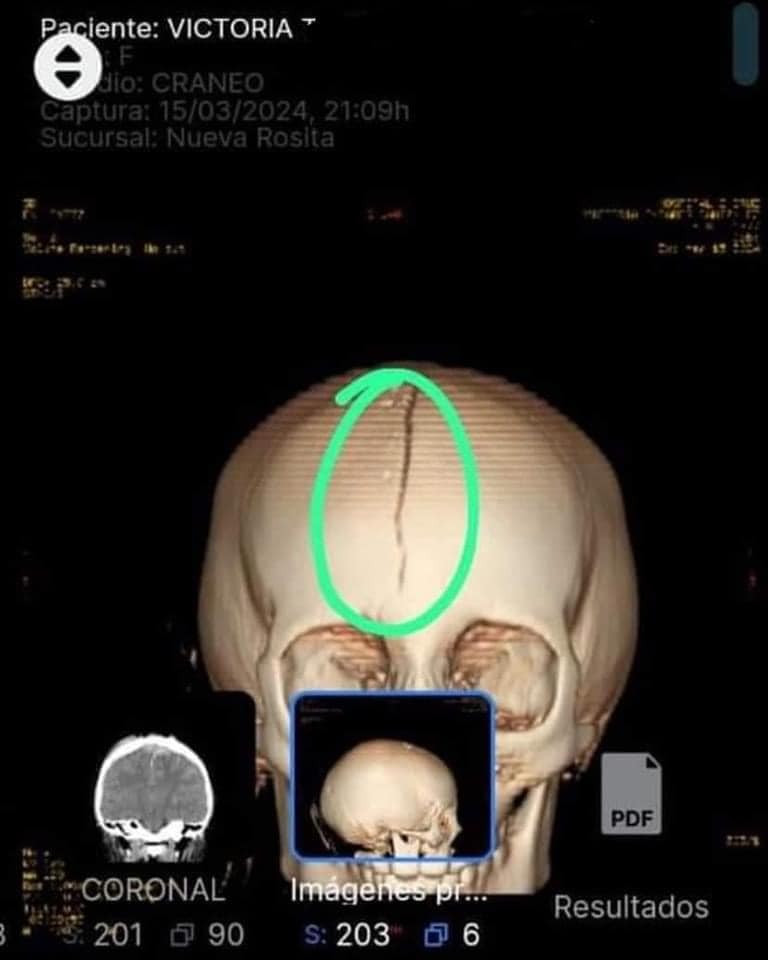 Trasladan a Monterrey a Victoria, niña herida en granizada en la Región Carbonífera