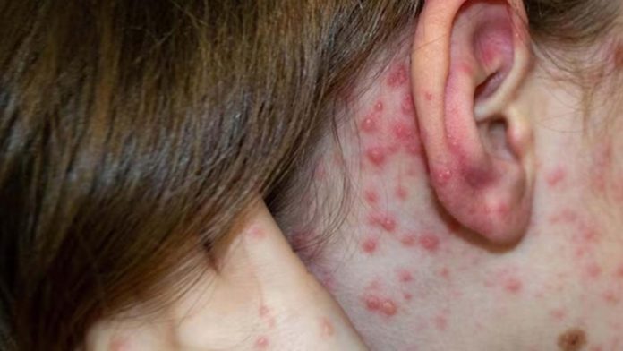 Aumenta 31% la varicela en Coahuila: ¿Cómo prevenirla?