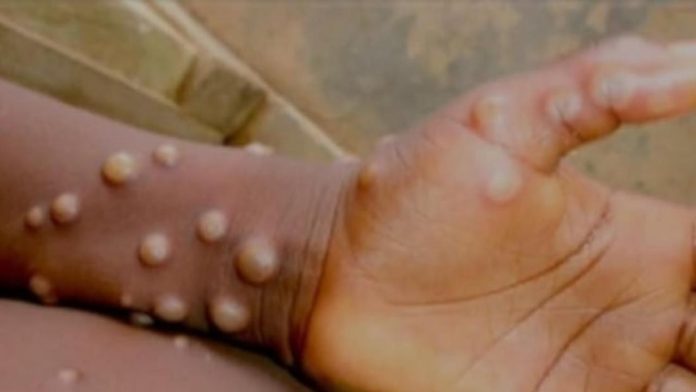 La OMS declara emergencia sanitaria internacional el nuevo brote de mpox