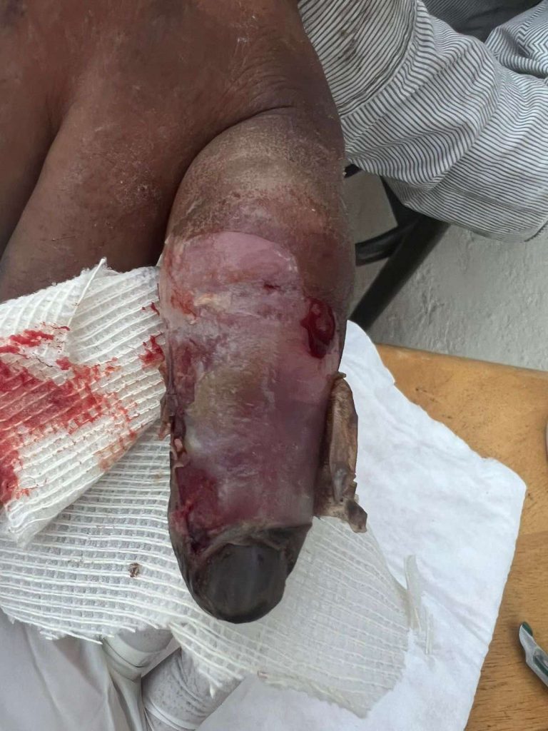 A punto de perder dedo por piquete de araña violinista