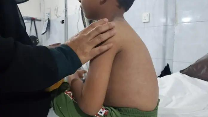 Casos de sarampión aumentan; confirman 713 casos en un estado