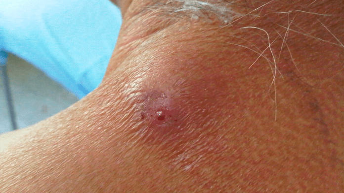 Confirman nuevos casos de miasis por gusano barrenador; ya son 23