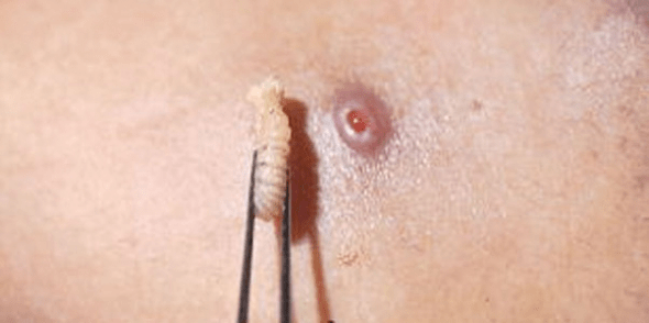 Confirman nuevos casos de miasis por gusano barrenador; ya son 23