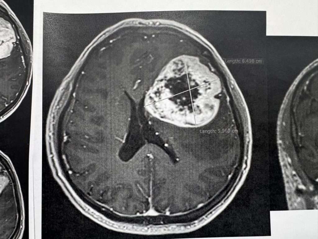 Retiran tumor cerebral con técnica de paciente despierto en el CMN "20 de Noviembre" del ISSSTE