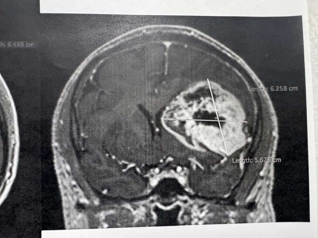 Retiran tumor cerebral con técnica de paciente despierto en el CMN "20 de Noviembre" del ISSSTE