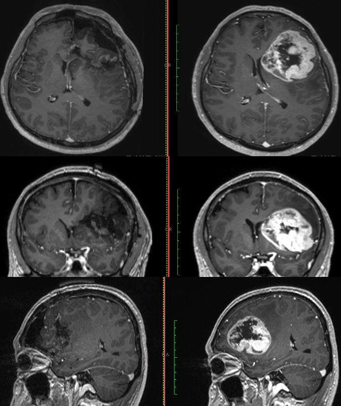 Retiran tumor cerebral con técnica de paciente despierto en el CMN "20 de Noviembre" del ISSSTE