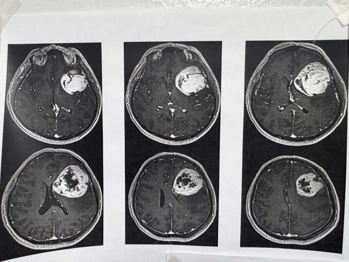 Retiran tumor cerebral con técnica de paciente despierto en el CMN 