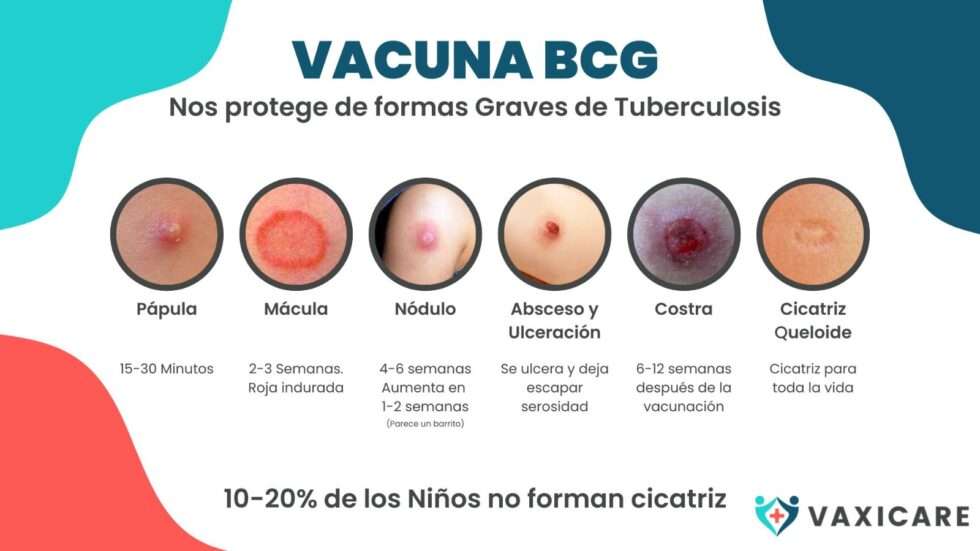 Vacuna BCG
