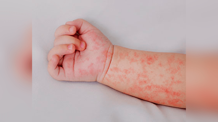 Sarampión en Durango