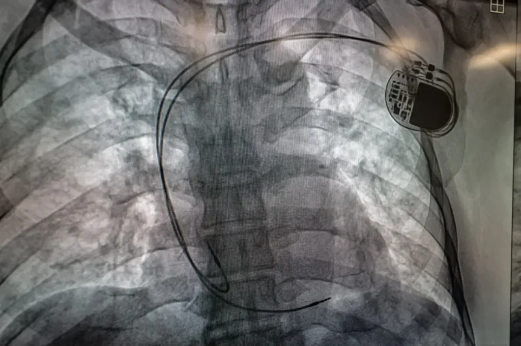 Brinda HRAE del ISSSTE en Acapulco atención especializada en salas de hemodiálisis y hemodinamia