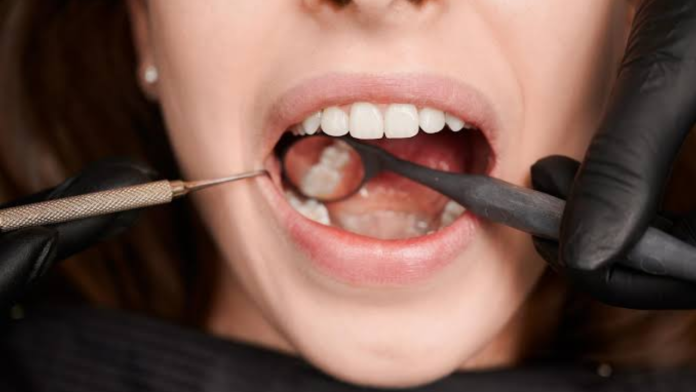 La caries no da tregua: problema de salud bucal también pega en Coahuila
